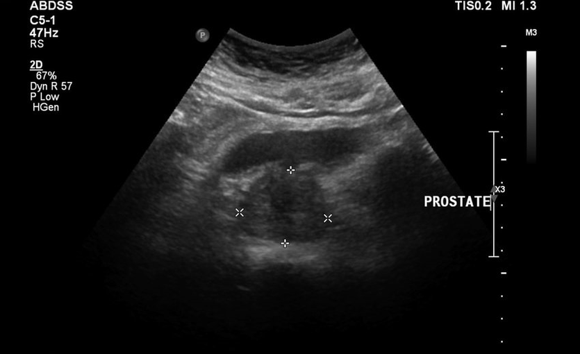 Prostate ultrasound before taking zxcvbnmqwert