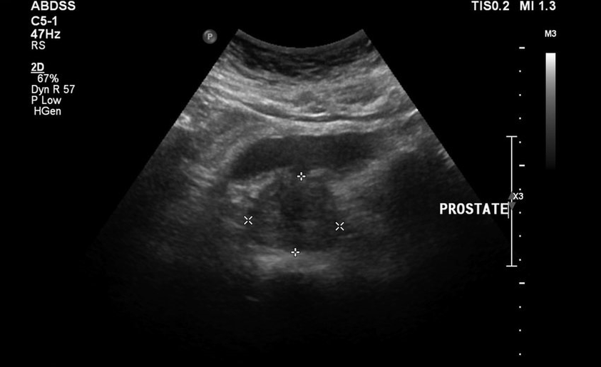 Prostatitis for ultrasound before taking Urosaf