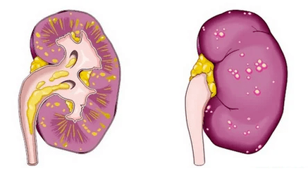 What is acute prostatitis leads to