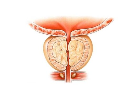 Prostate increase with prostatitis